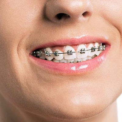 ưu điểm của phương pháp niềng răng mắc cài kim loại thường:
