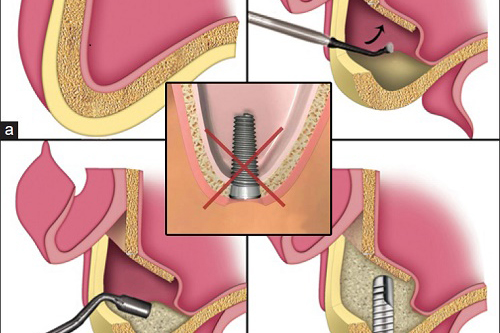 Nâng xoang – Ghép xương trong cấy ghép Implant là gì?